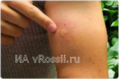 Уменьшить зуд от укуса комаров поможет вода с сахаром или солью